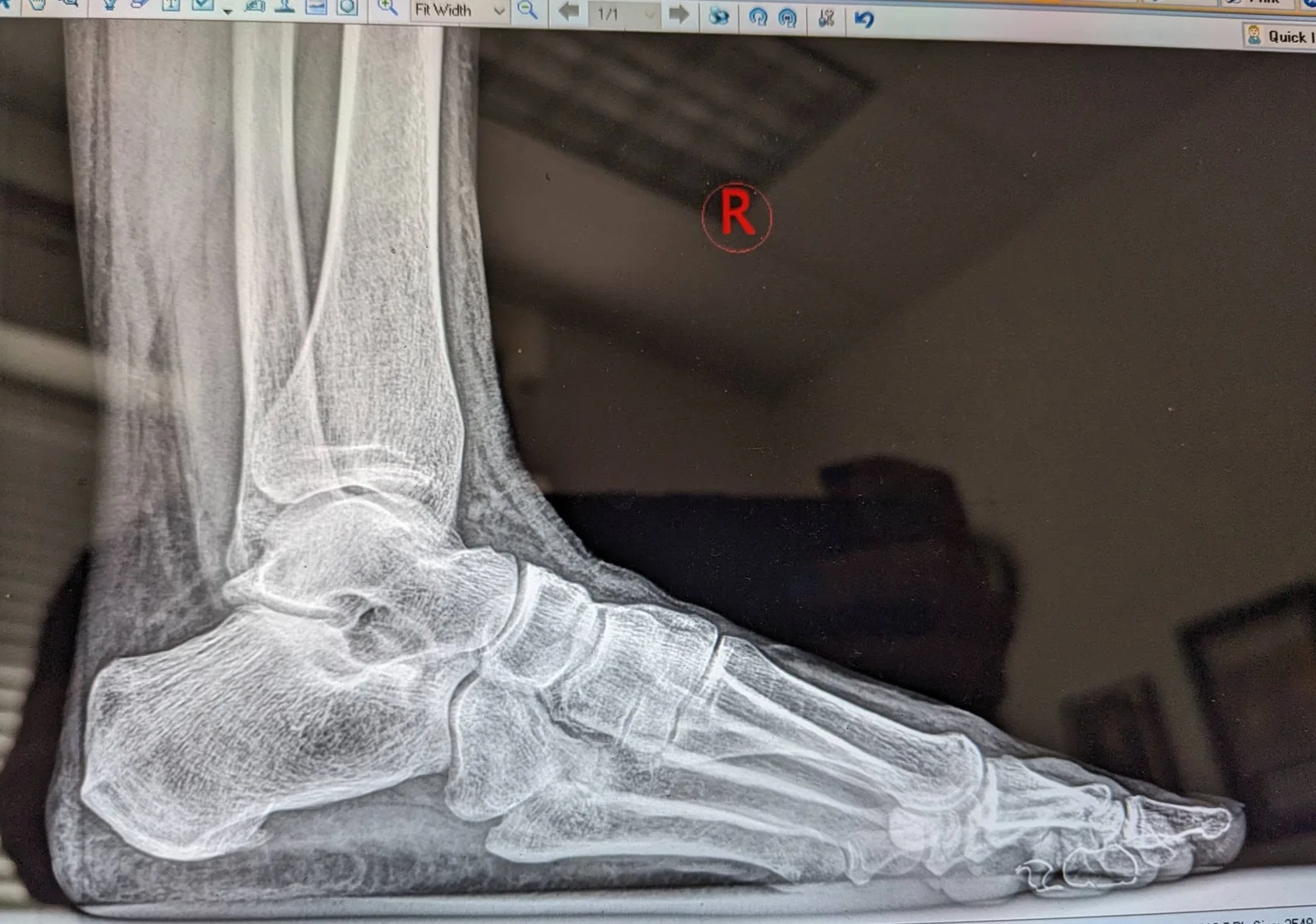 May be an image of xray and bone