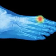 Can Surgery Cause Your Bunions to Come Back?