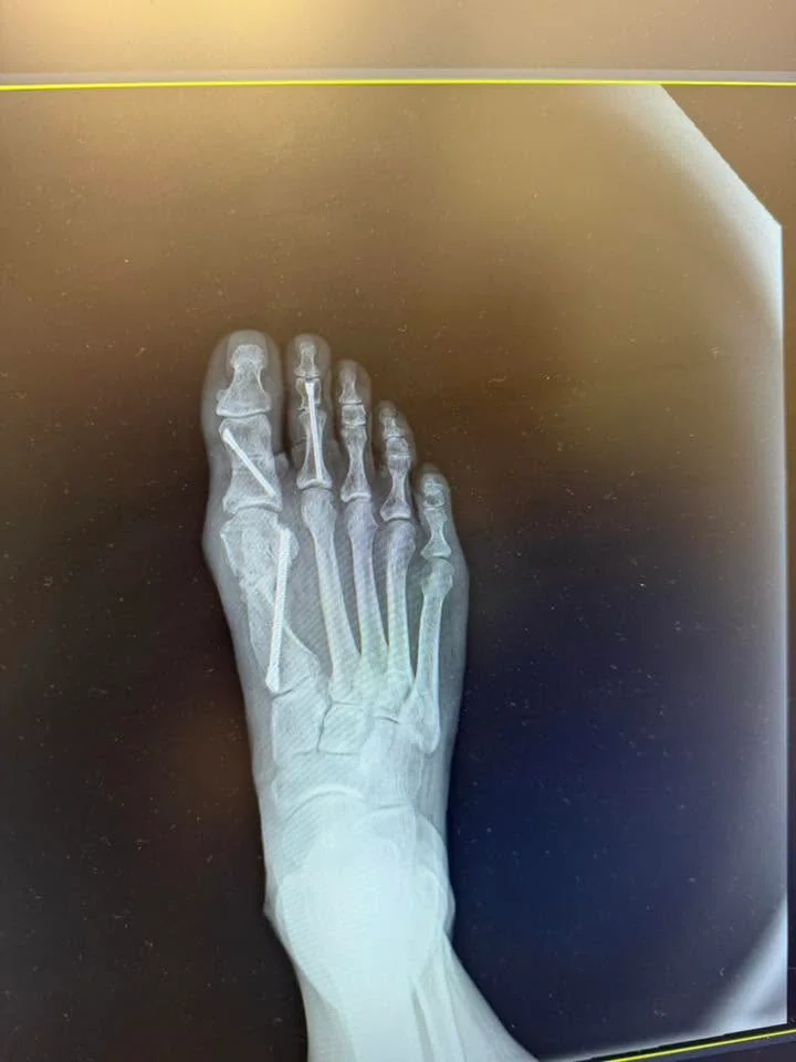 May be an image of xray and bone