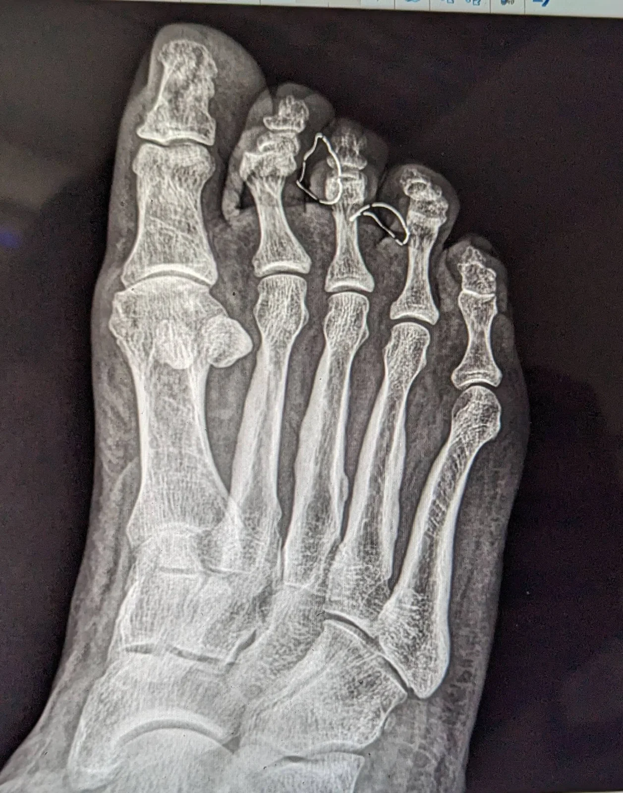 May be an image of bone and xray