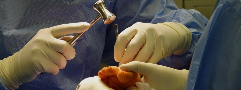 Hammer Toe Surgery & Correction